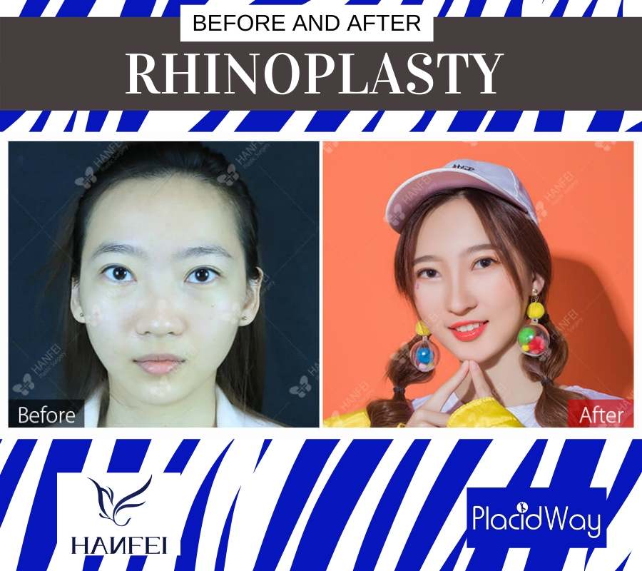 Rhinoplasty Before and After, Guangzhou, China